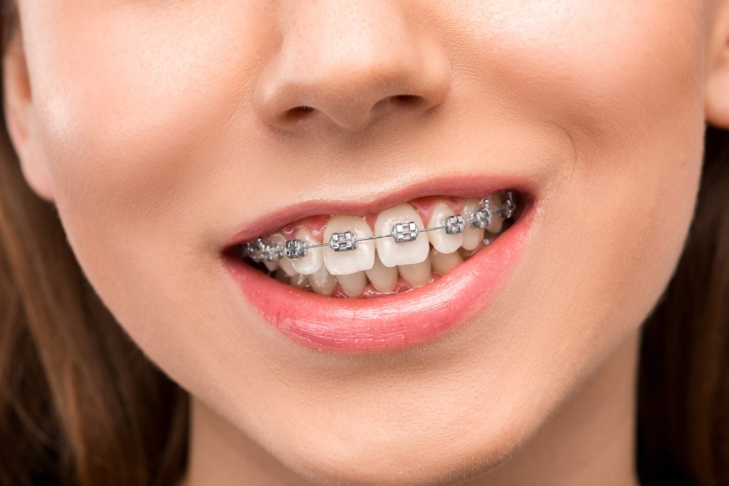 Orthodontics - Braces Treatment